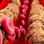 O primeiro sinal perceptível de colesterol alto para se atentar