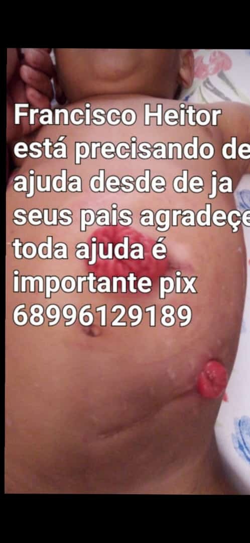 Família pede ajuda para custear tratamento de criança internada em São Paulo com doença no intestino