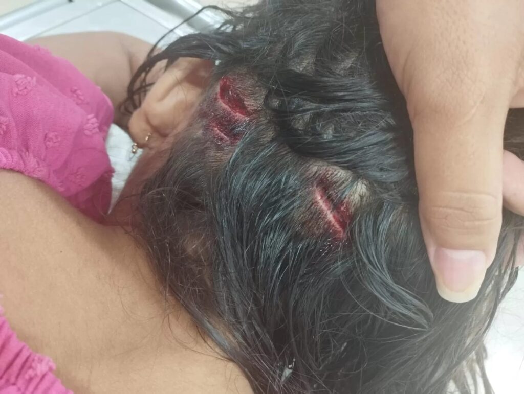 Cão da raça Pitbull ataca criança de 8 anos no município de Capixaba