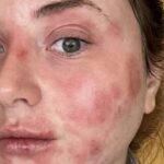 Jovem tem grave alergia de pele após uso de lente de contato Jovem tem grave alergia de pele após uso de lente de contato
