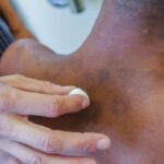 Filhos de isolados por hanseníase no passado vão receber pensão Filhos de isolados por hanseníase no passado vão receber pensão