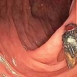 Médicos descobrem mosca viva e intacta dentro do intestino de idoso