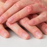 Pacientes com lúpus cutâneo podem ter nova opção de tratamento