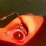 Mais de 60 larvas são retiradas dos olhos de mulher durante cirurgia