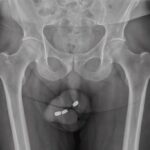Idoso insere baterias na ureta e perde parte do órgão genital