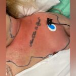 Infecção por bactéria “comedora de carne” quase leva mulher à morte