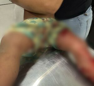 Criança de 7 anos é vítima de ataque de pitbull em Sena Madureira