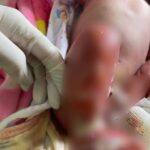 AURORA: Caso de bebê que sofreu queimaduras em Hospital de Cruzeiro do Sul vira notícia nacional AURORA: Caso de bebê que sofreu queimaduras em Hospital de Cruzeiro do Sul vira notícia nacional