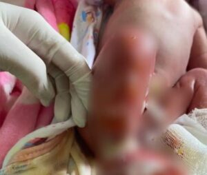 AURORA: Caso de bebê que sofreu queimaduras em Hospital de Cruzeiro do Sul vira notícia nacional