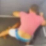 Mulher espancada dentro de elevador precisou de malha de titânio para reconstruir rosto