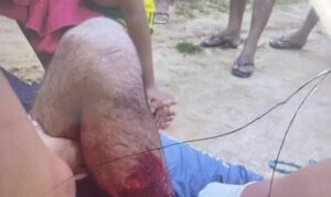 Indígena Puyanawa é operado com sucesso após disparo acidental durante caça em Mâncio Lima