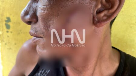Homem fica ferido com cortes no rosto após briga com mulher em Manoel Urbano