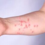 Exame descarta mpox em paciente de 40 anos em Rio Branco; secretário destaca eficiência da vigilância