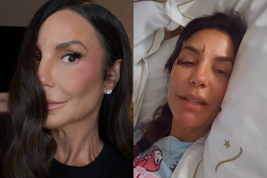 Ivete Sangalo mostra hematoma no rosto após acidente