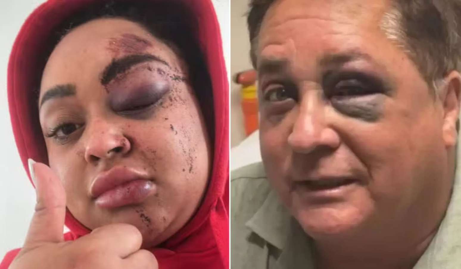 Ex-BBB Rízia Cerqueira brinca ao comparar olho roxo com Leonardo: 'Passada que estamos iguais' Ex-BBB Rízia Cerqueira brinca ao comparar olho roxo com Leonardo: 'Passada que estamos iguais'