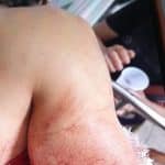 Homem sofre golpe de facão e quase tem braço decepado após dar carona para mulher casada em Brasiléia