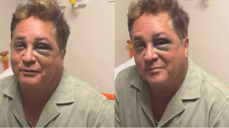 Leonardo revela fratura no rosto após queda em pescaria e admite: 'Estava mamado' Leonardo revela fratura no rosto após queda em pescaria e admite: 'Estava mamado'