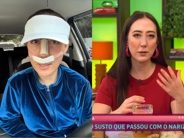 Repórter do ‘Mais Você’ revela risco de perder o nariz após erro médico em cirurgia: ‘Pode necrosar’