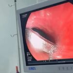 Menino de 6 anos engole moeda e passa por procedimento bem‑sucedido em Cruzeiro do Sul
