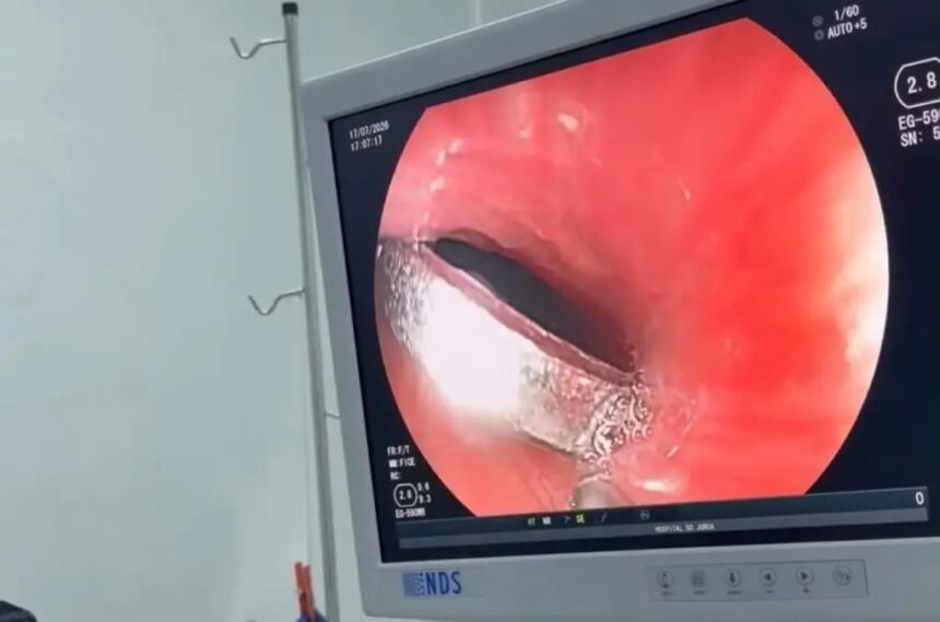 Menino de 6 anos engole moeda e passa por procedimento bem‑sucedido em Cruzeiro do Sul Menino de 6 anos engole moeda e passa por procedimento bem‑sucedido em Cruzeiro do Sul